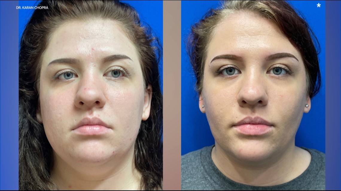 Buccal Fat Removal NYC: Sculpt Your Face with Confidence